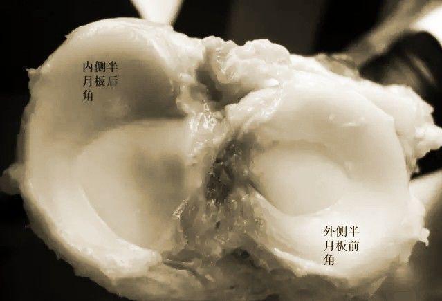而在胫骨上端的关节面上垫有两块半月形的软骨,称为内,外侧半月板.