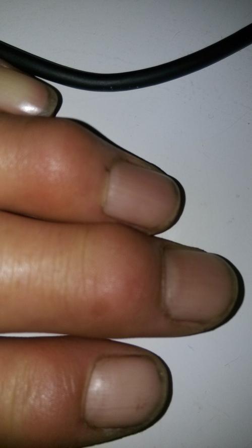 手指第一关节逐渐开始肿大,导致手指不方便弯曲,用力大的时候疼痛