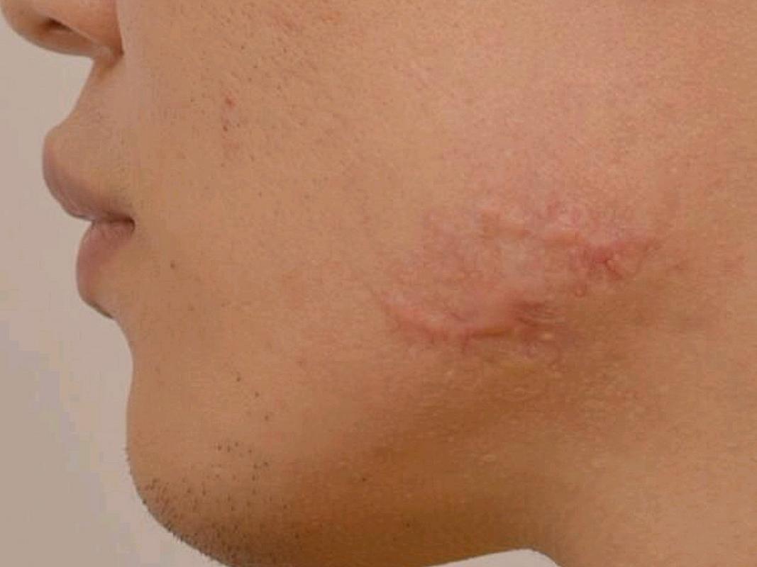 疤痕增生是一种常见的皮肤问题,它会造成皮肤的凸起和颜色的改变,给