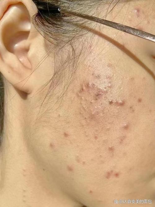脸颊长痘痘是什么原因,痘痘是个俗称,医学上称之为痤疮.
