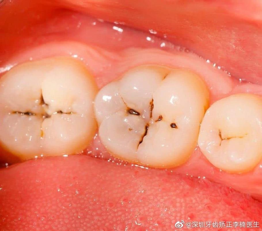 深圳牙齿矫正李楠医生:牙齿上有个洞,应该怎么办?