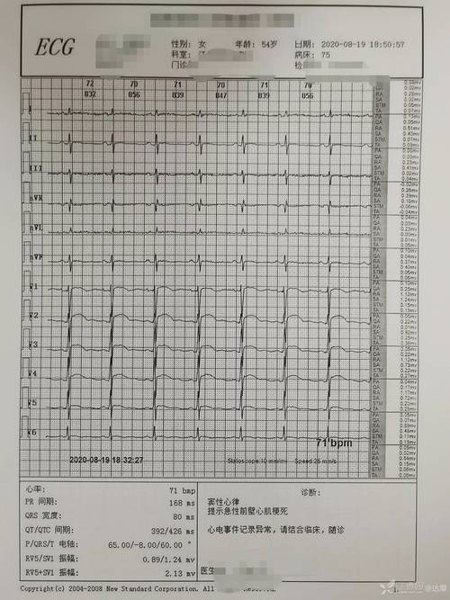2 年多次心电图都报「心肌梗死」,但病人「安然无恙」,究竟是什么病?