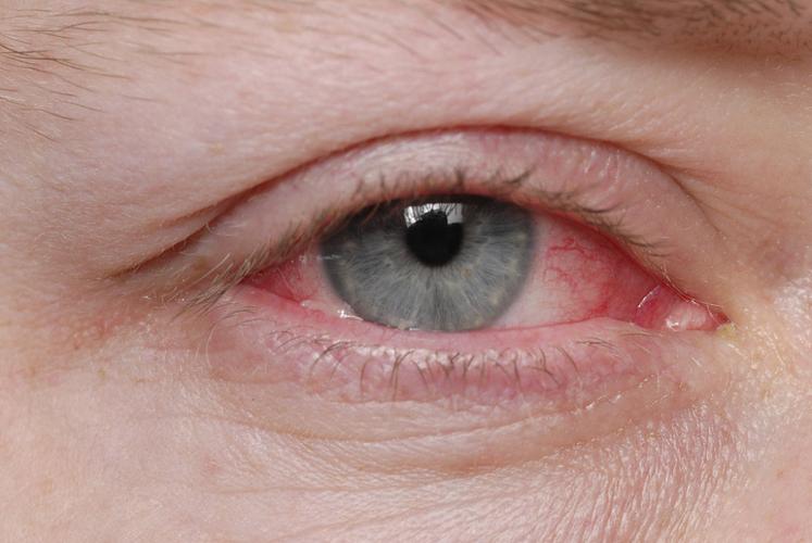 眼睛红血丝是怎么回事 一觉醒来眼睛红血丝是怎么回事