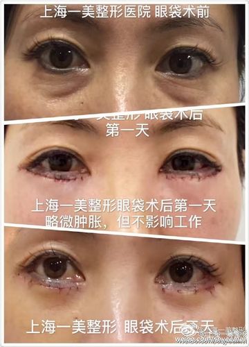 【上海一美】精细手术效果,外切眼袋三天就. 来自上海一美整形 - 微博