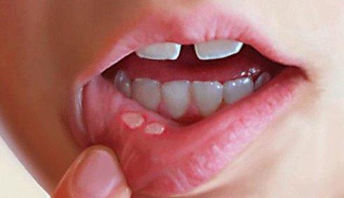口腔溃疡吃消炎药有用吗