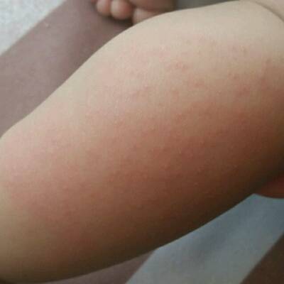 宝宝腿上突然出现一片红疹子,不知道怎麼起的,有知道是什麼的吗?