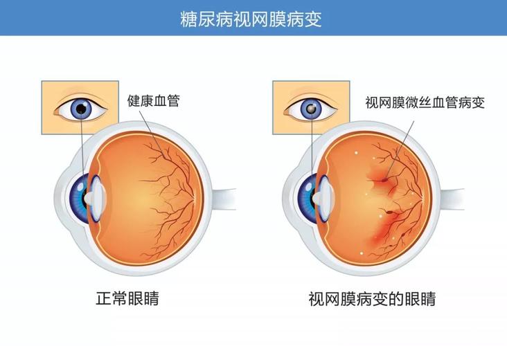 糖尿病视网膜病变,一种容易致盲的眼疾