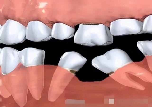 导致牙列里牙齿不完整,影响美观,咀嚼功能及其他牙齿的发育等.