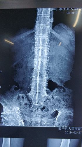 黔东南州人民医院黎平医院骨科顺利完成一例强直性脊柱炎的强直髋全髋